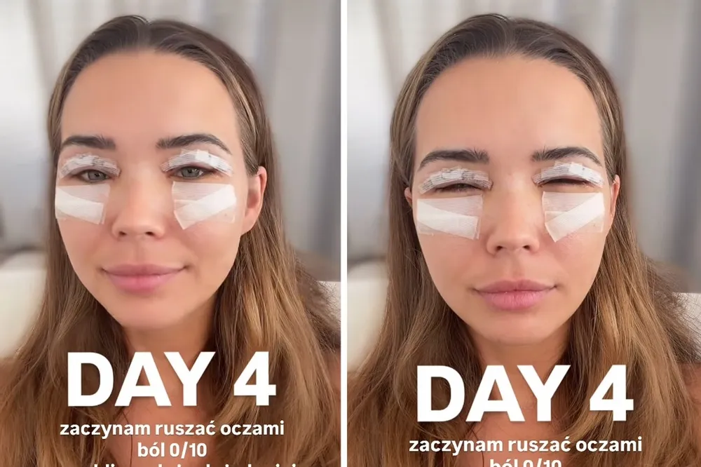 Sandra Kubicka pokazała, jak wygląda po operacji powiek. "Zaczynam ruszać oczami"